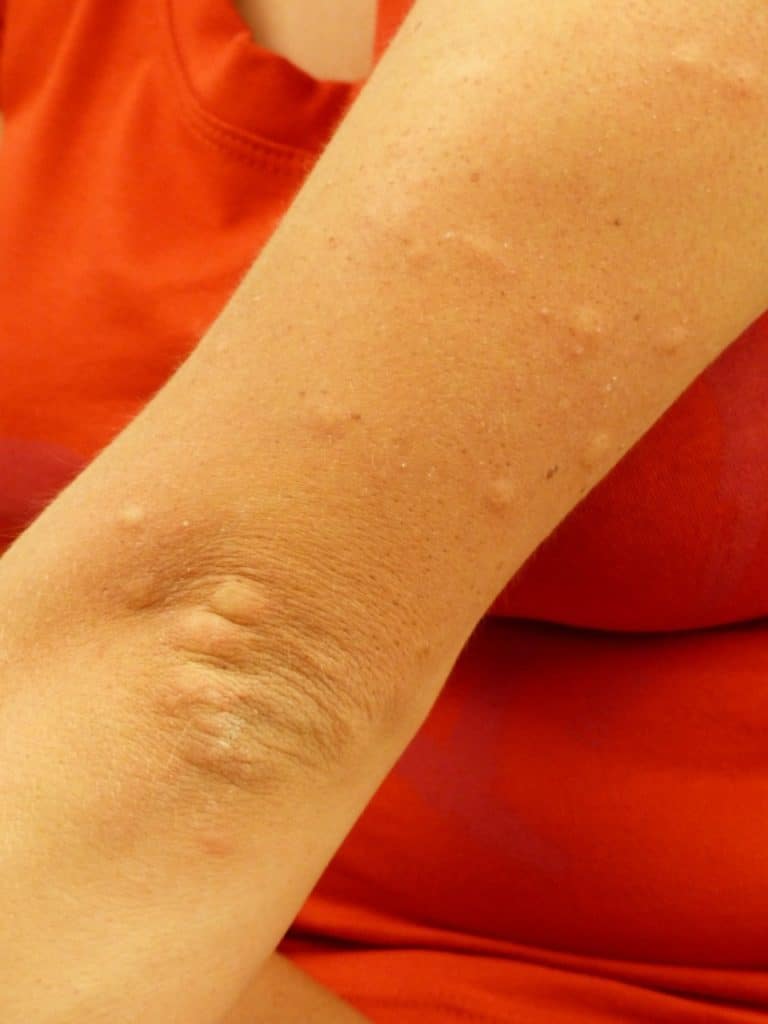 Are there mosquitoes in Fuerteventura - mozzie bites on an arm